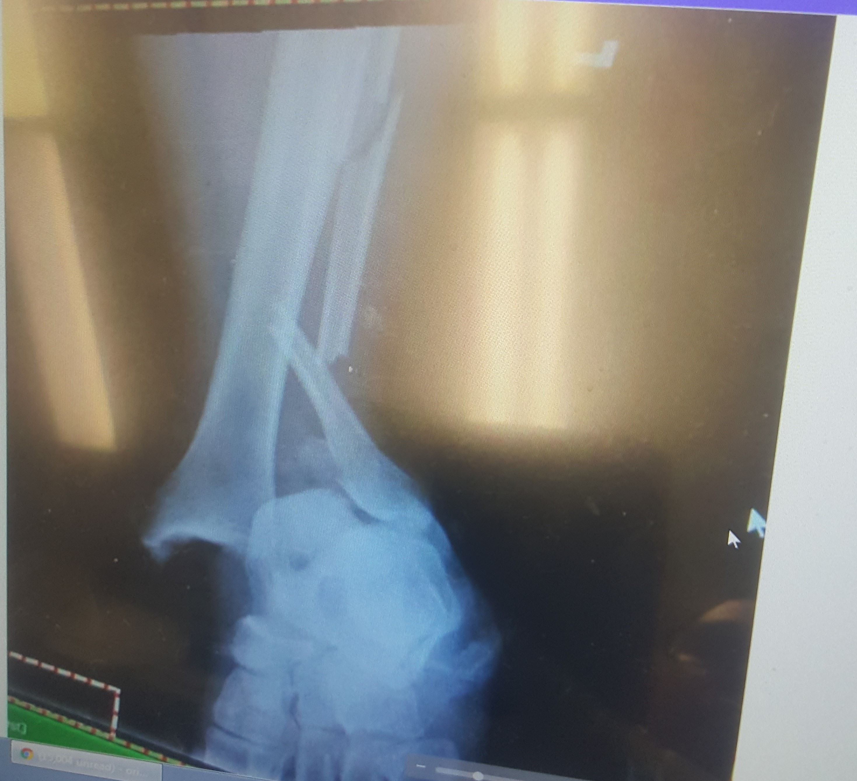X-ray of broken bones in patient's leg